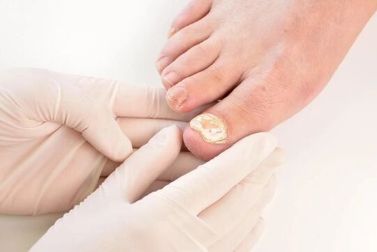 Doctors recommend Fungent to treat athlete's foot