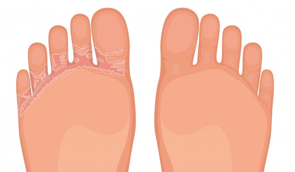 Fungent works against all types of athlete's foot