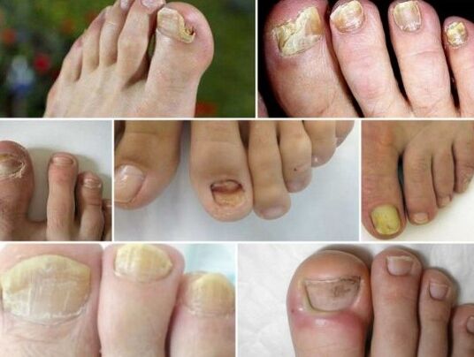 Different forms of nail fungi