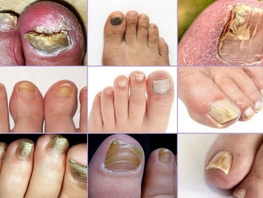 Nail damage in different types of mushrooms