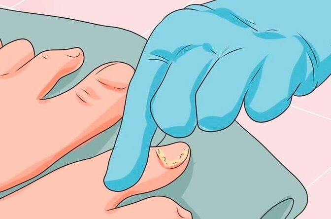The first signs of nail mycosis