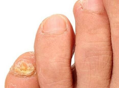 The fungus on the legs