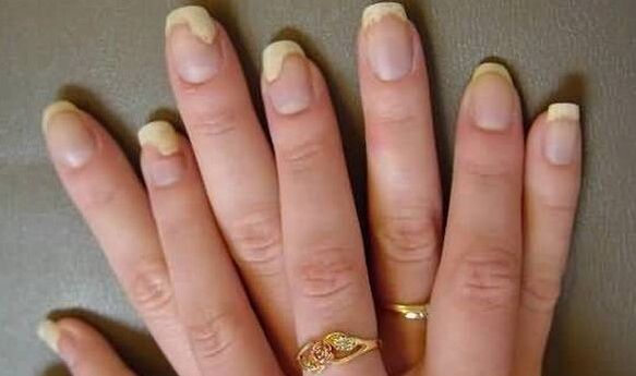 This is what the nail fungus looks like in the exacerbation phase