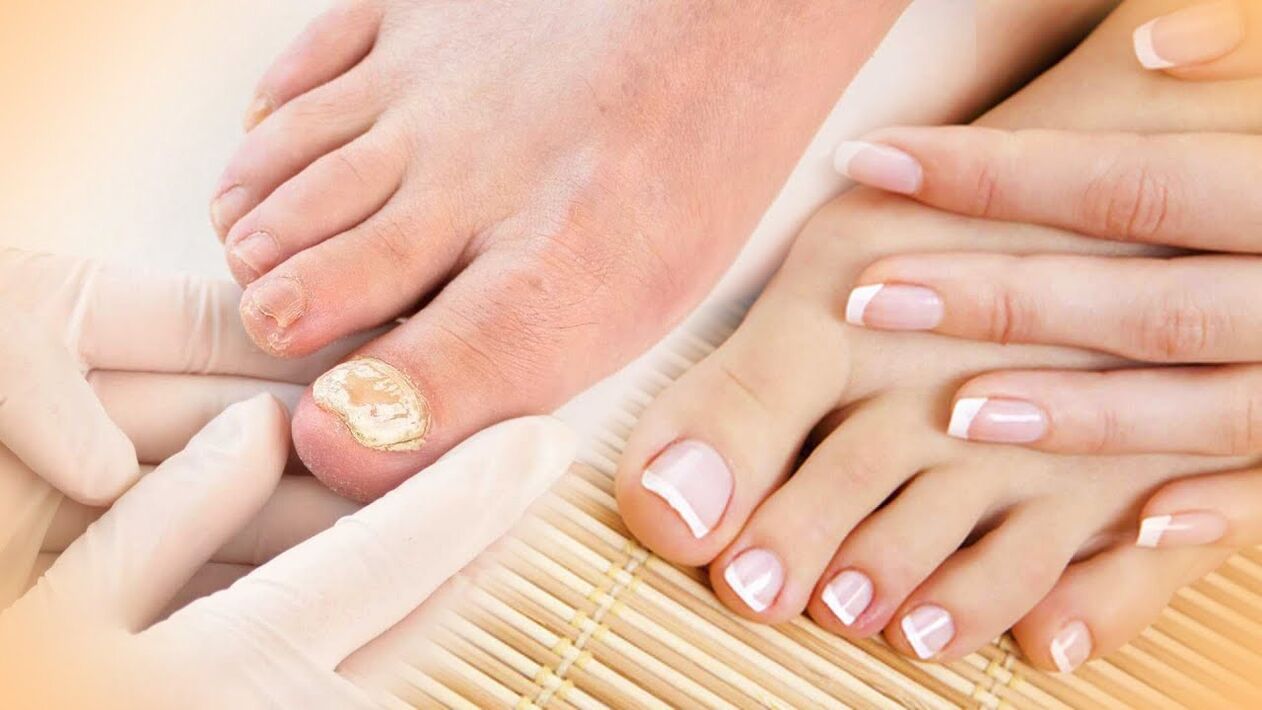 Nail fungus