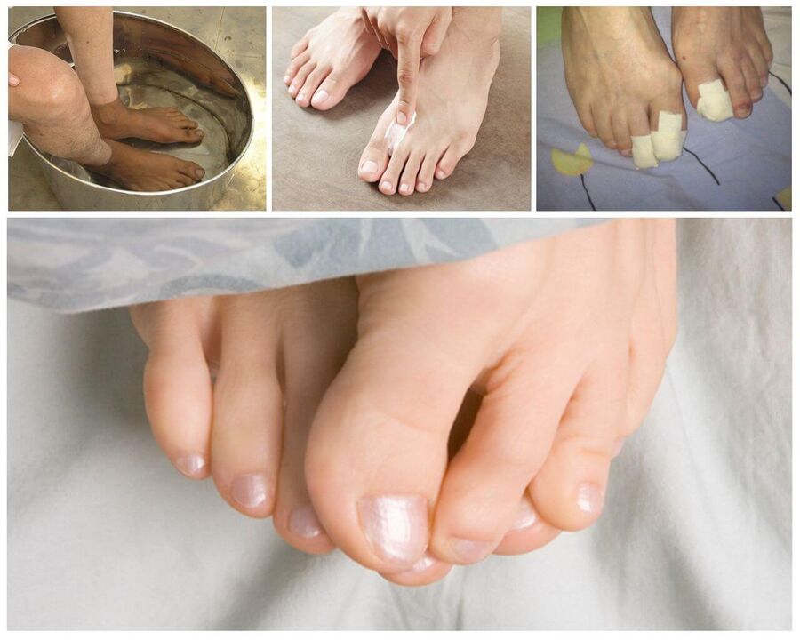Treatment of mushroom