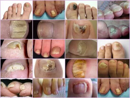 Onychomycosis of different localization on the nail