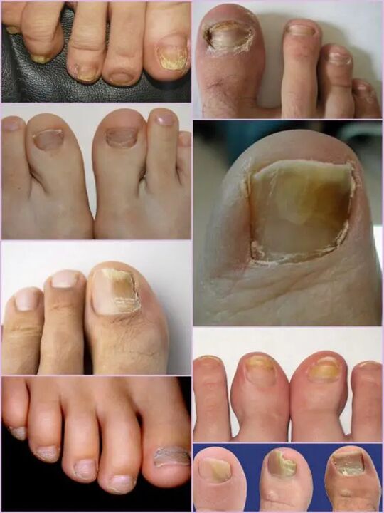 Varieties of nail fungus