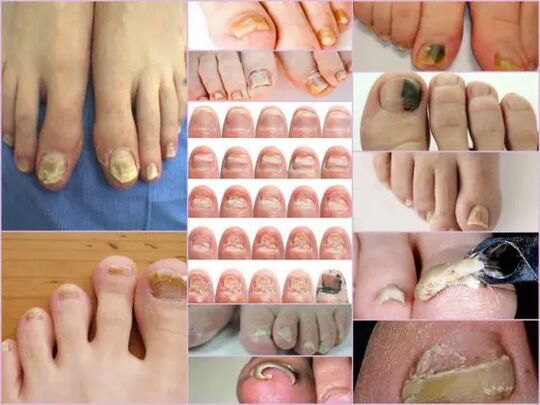 Varieties of onychomycosis