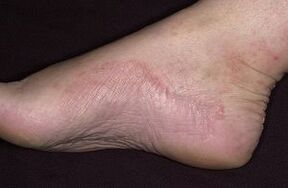 The mushroom damage on the foot