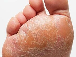 The mushroom of the foot
