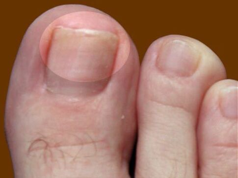 The lesion of the mushroom