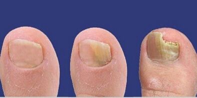 Development phases of nail fungus